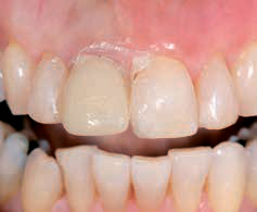 Luxatemp PLUS - проверка окклюзии